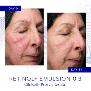 Clinical before and after photos showing visibly reduced facial redness and more even skin tone after 84 days of iS Clinical Retinol+ Emulsion 0.3 use, clinically proven results