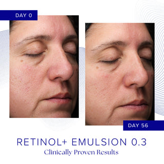 Clinical before and after photos showing reduced redness and refined skin texture after 56 days of iS Clinical Retinol+ Emulsion 0.3 use, clinically proven results