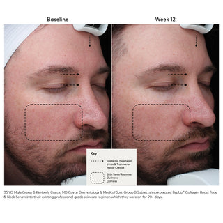 Colorescience Pep Up Collagen Boost Serum before and after: 33-year-old male showing reduced forehead lines, nasal crease, redness, and oiliness after 12 weeks.
