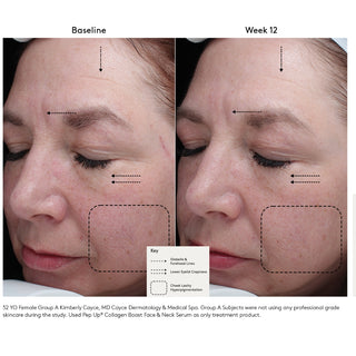 Colorescience Pep Up Collagen Boost Serum before and after: 52-year-old female showing reduced forehead lines, lower eyelid crepiness, and cheek hyperpigmentation after 12 weeks.