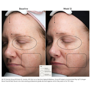 Colorescience Pep Up Collagen Boost Serum before and after: 46-year-old female showing improved forehead lines, upper eyelid laxity, and cheek hyperpigmentation after 12 weeks.