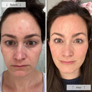 Side-by-side before-and-after showing a woman with visibly reduced acne, redness, and more even skin tone after using the Omnilux Contour Face LED mask.