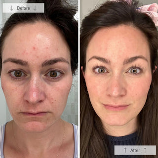 Side-by-side before-and-after showing a woman with visibly reduced acne, redness, and more even skin tone after using the Omnilux Contour Face LED mask.