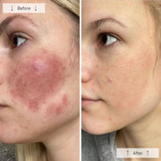 Side-by-side before-and-after showing a woman with significantly reduced facial redness and more even skin tone after using the Omnilux Contour Face LED mask.