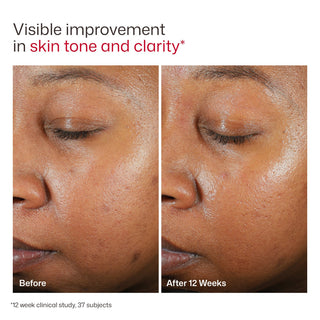 Before and after 12 weeks using EltaMD UV Clear Untinted SPF 46, visible improvement in skin tone and clarity