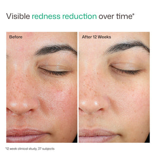 Before and after 12 weeks using EltaMD UV Skin Recovery Green Tinted SPF 50, clinically proven redness reduction