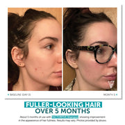 FACTORFIVE Shampoo before and after side profile comparison showing visibly fuller and thicker looking hair from baseline Day 0 to 5 months of use