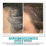 FACTORFIVE Shampoo before and after hairline comparison showing visibly reduced thinning and improved hair density from baseline Day 0 to Week 8