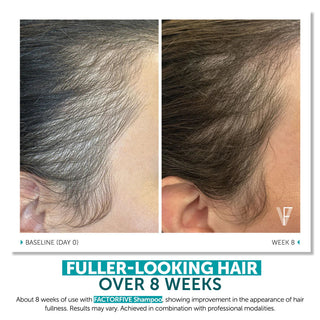 FACTORFIVE Shampoo before and after temple area comparison showing visibly increased hair fullness and density from baseline Day 0 to Week 8