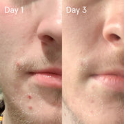 Face Reality Sulfur Spot Treatment before and after – visible reduction in acne breakouts from day 1 to day 3