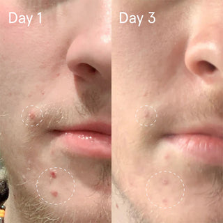 Face Reality Sulfur Spot Treatment before and after – visible reduction in acne breakouts from day 1 to day 3