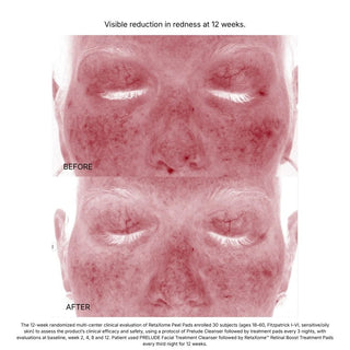 Before and after face showing visible redness reduction at 12 weeks using RetaXome Pads