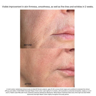 Before and after mouth area showing smoother skin, fewer wrinkles using Célthera Repair Cream