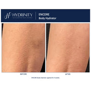 Hydrinity Encore Body Hydrator before and after comparison showing visibly smoother skin texture and reduced stretch mark appearance on body skin after 4 weeks of daily use