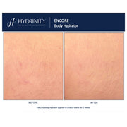 Hydrinity Encore Body Hydrator before and after comparison showing visibly reduced redness and improved appearance of stretch marks after 2 weeks of daily use
