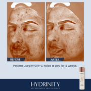 Before and after effects of HYDRI-C Daily Vitamin C Moisturizer on a person's face, showing visible brightness.