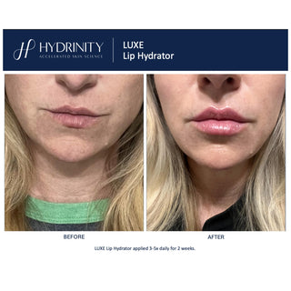 Hydrinity Luxe Lip Hydrator before and after comparison showing visibly fuller, smoother, and more hydrated lips after 2 weeks of use applied 3 to 5 times daily