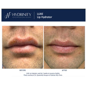 Hydrinity Luxe Lip Hydrator before and after comparison showing significant improvement in lip eczema cheilitis after 2 weeks of daily use
