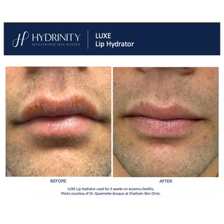 Hydrinity Luxe Lip Hydrator before and after comparison showing significant improvement in lip eczema cheilitis after 2 weeks of daily use