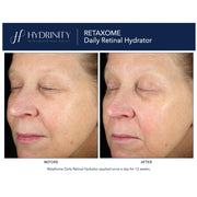 Hydrinity Retaxome Daily Retinal Hydrator before and after comparison showing visibly smoother skin texture and reduced fine lines after 12 weeks of daily use