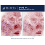 Hydrinity Retaxome Daily Retinal Hydrator before and after comparison showing visible reduction in skin redness and surface irregularities after 2 weeks of daily use
