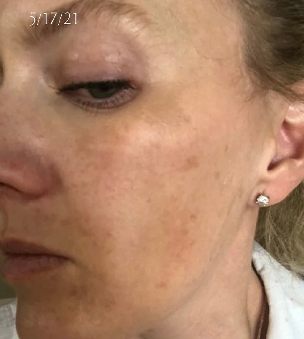 Hyperpigmentation