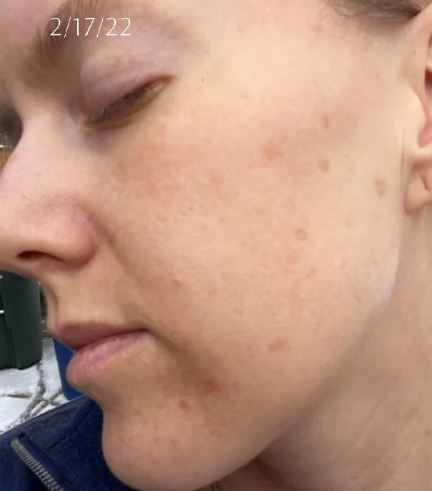 Hyperpigmentation