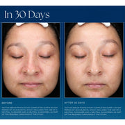 Clinical before and after full-face photos showing reduced hyperpigmentation and more even skin tone after 30 days of iS Clinical Active Serum use