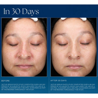 Clinical before and after full-face photos showing reduced hyperpigmentation and more even skin tone after 30 days of iS Clinical Active Serum use