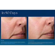 Clinical before and after close-up photos showing reduced fine lines and more even skin texture around the nose and cheek area after 90 days of iS Clinical Active Serum use