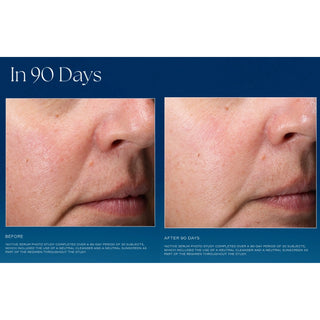 Clinical before and after close-up photos showing reduced fine lines and more even skin texture around the nose and cheek area after 90 days of iS Clinical Active Serum use
