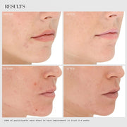 LightStim for Acne before and after results showing visibly clearer skin and reduced breakouts in two participants within 2 to 4 weeks of LED light therapy treatment