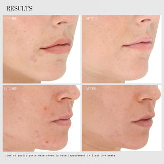 LightStim for Acne before and after results showing visibly clearer skin and reduced breakouts in two participants within 2 to 4 weeks of LED light therapy treatment