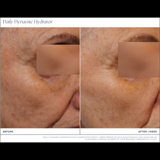 Clinical before and after close-up photos showing improved skin texture and reduced fine lines around the eye area after 1 week of iS Clinical Daily Dynamic Hydrator use