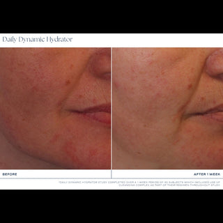 Clinical before and after close-up photos showing reduced redness and smoother skin texture around the cheek and mouth area after 1 week of iS Clinical Daily Dynamic Hydrator use