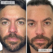 Side-by-side before-and-after showing a bearded man with visibly reduced redness and more even skin tone after using the Omnilux Men LED mask.