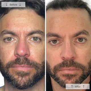 Side-by-side before-and-after showing a bearded man with visibly reduced redness and more even skin tone after using the Omnilux Men LED mask.
