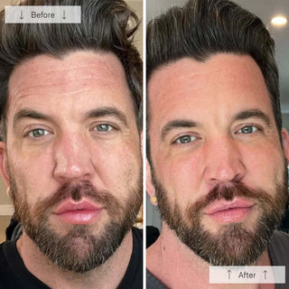 Side-by-side before-and-after showing a bearded man with visibly reduced redness, fine lines, and more even skin tone after using the Omnilux Men LED mask.