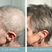 NeoGenesis Hair Thickening Serum before and after side view showing significant hair regrowth after chemotherapy hair loss, from sparse regrowth at 5.5 weeks to full short hair at 6.5 months