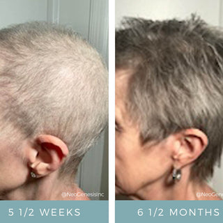NeoGenesis Hair Thickening Serum before and after side view showing significant hair regrowth after chemotherapy hair loss, from sparse regrowth at 5.5 weeks to full short hair at 6.5 months