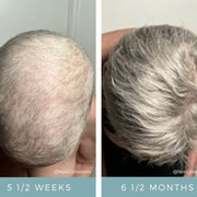 NeoGenesis Hair Thickening Serum before and after top view showing dramatic hair regrowth after chemotherapy hair loss, from minimal coverage at 5.5 weeks to full thick hair at 6.5 months