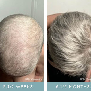 NeoGenesis Hair Thickening Serum before and after top view showing dramatic hair regrowth after chemotherapy hair loss, from minimal coverage at 5.5 weeks to full thick hair at 6.5 months