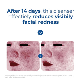 Before and after 14 days using EltaMD Skin Recovery Amino Acid Foaming Cleanser, visibly reduced facial redness
