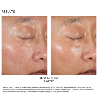 Skinbetter A-Team Duo Kit before and after 4 weeks: visibly less redness and more even skin tone on cheek