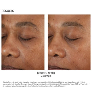 Skinbetter A-Team Duo Kit before and after 4 weeks: smoother, more even-looking skin on a deeper skin tone