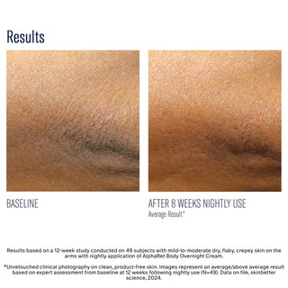 Skinbetter AlphaRet Body Overnight Cream before and after – reduced dryness after 8 weeks nightly use clinical results
