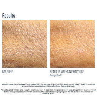 Skinbetter AlphaRet Body Overnight Cream before and after – reduced flaking after 12 weeks nightly use clinical results