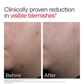 EltaMD UV Clear SPF 50 clinical before and after – proven reduction in visible blemishes and pore size for acne-prone oily skin