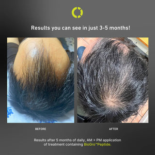 Kizo Lab Follicle Activator Hair Serum before and after pictures