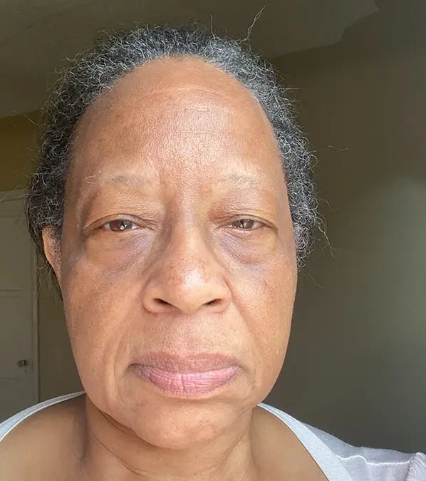 Hyperpigmentation